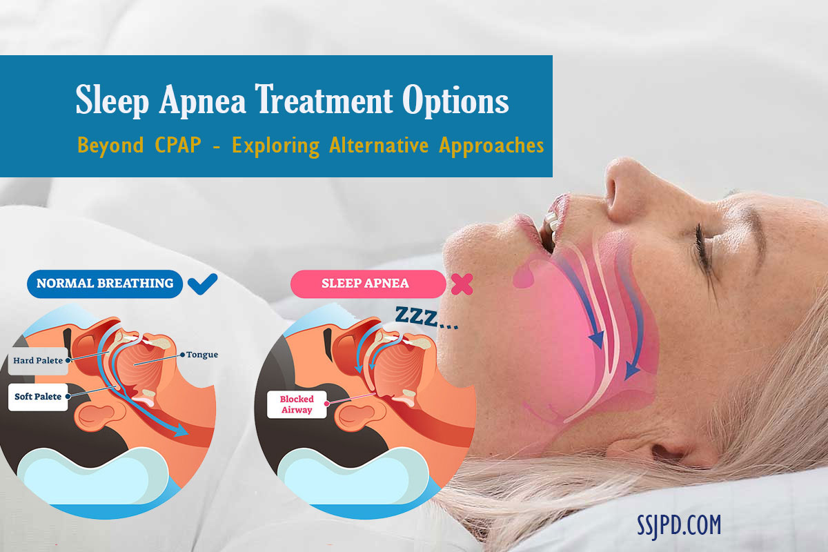 Sleep Apnea Treatment Options: Beyond CPAP - Exploring Alternative ...